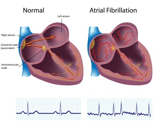 Atrial Fibbrilation.jpg